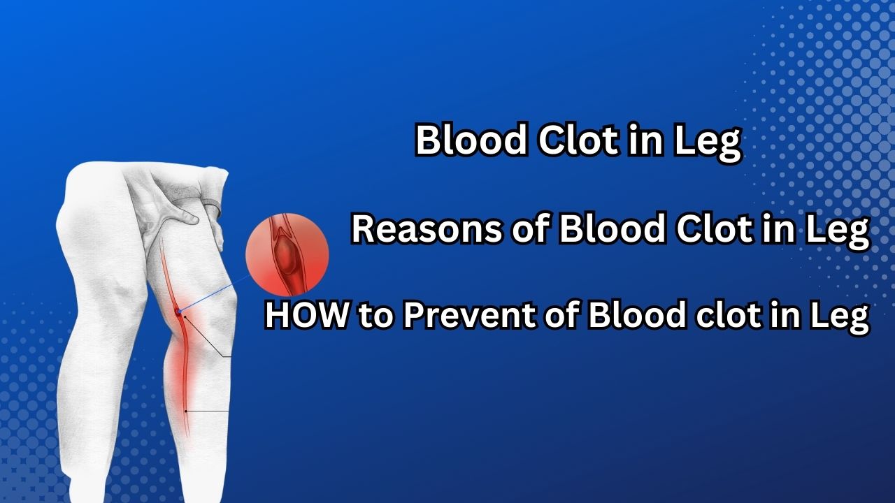 Blood Clot In Leg Reasons Of Blood Clot In Leg HOW To Prevent Of