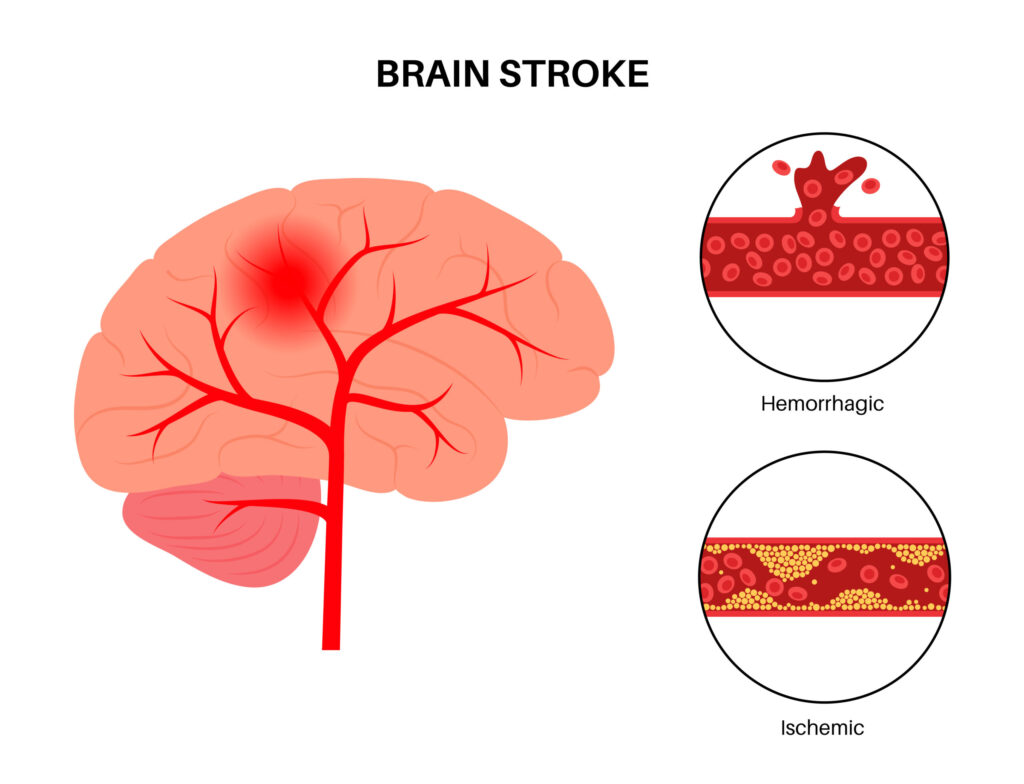 Causes of Brain Stroke Intervention Radiology Indore