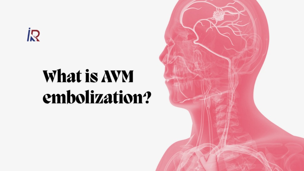 What is AVM embolization?