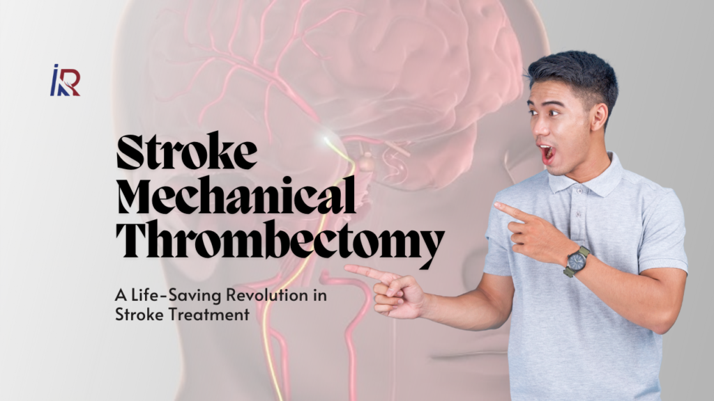 Stroke Mechanical Thrombectomy