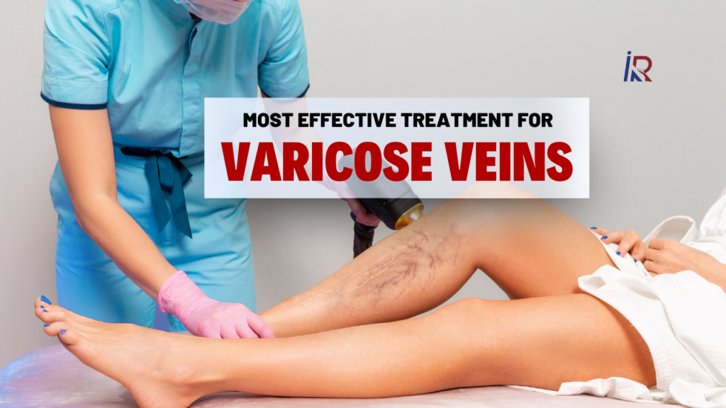 Most Effective Treatment for Varicose Veins