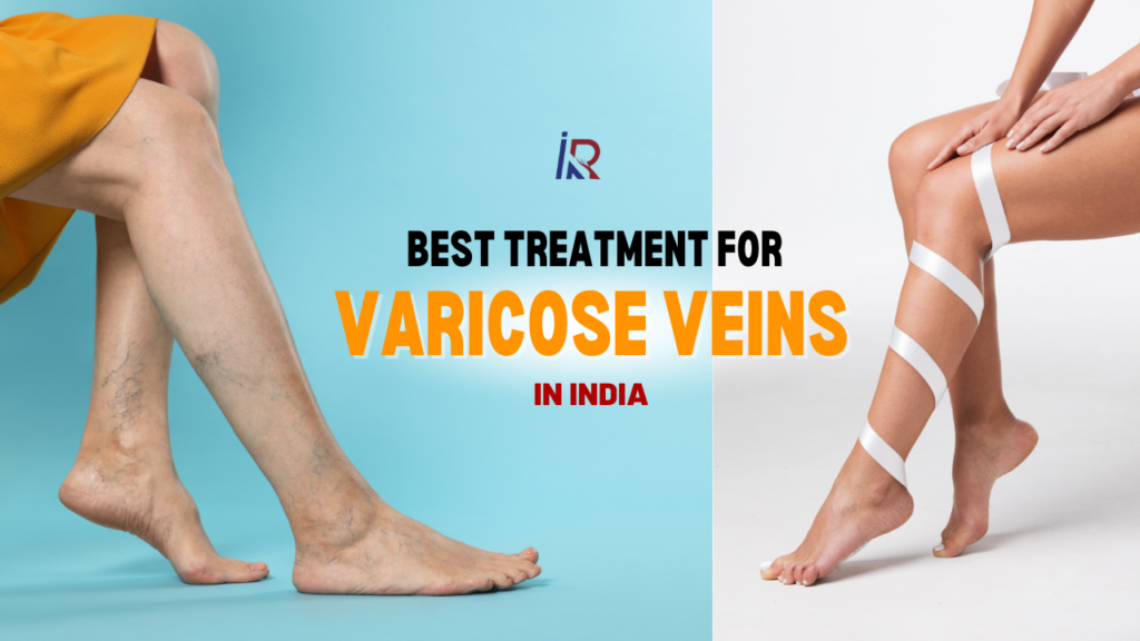Varicose Vein Doctor in Indore