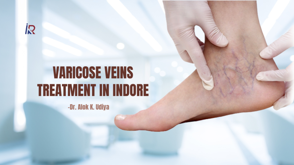 Varicose Veins Treatment in Indore