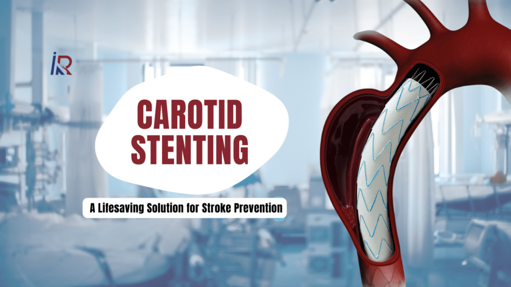 Carotid Stenting