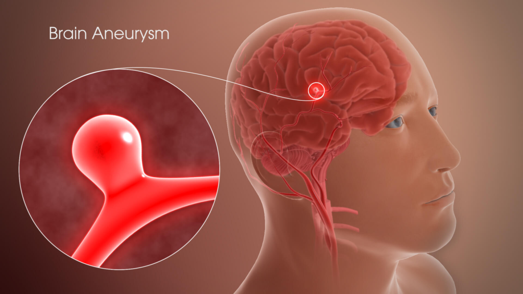 Top Brain Aneurysm Treatment Doctor in Indore