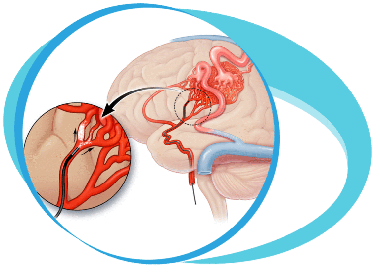 Embotech Avm AVM Embolization: A Life-Saving Procedure