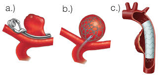 Cerebral Aneurysm Treatment in Indore – Advanced, Safe & Minimally Invasive Care 2 Cerebral Aneurysm Treatment in Indore
