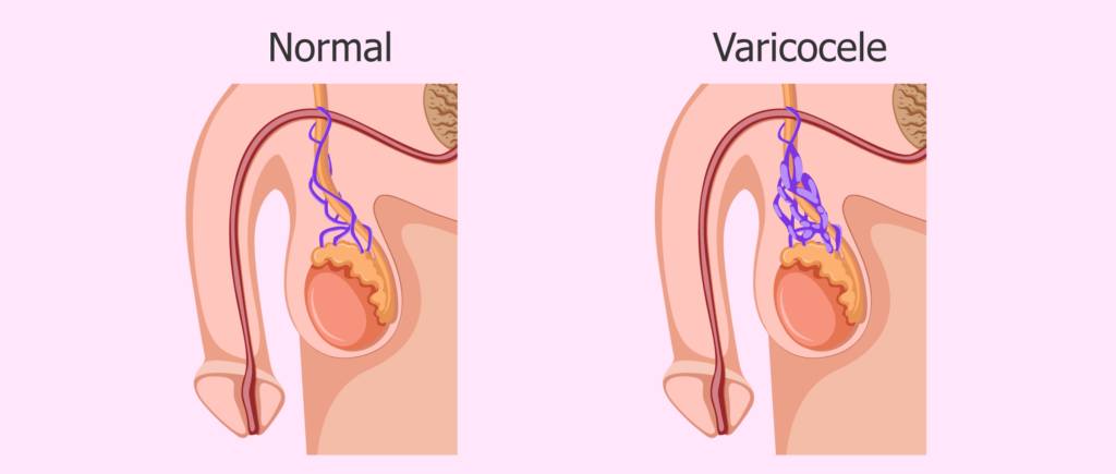 Varicocele Embolization vs Surgery
