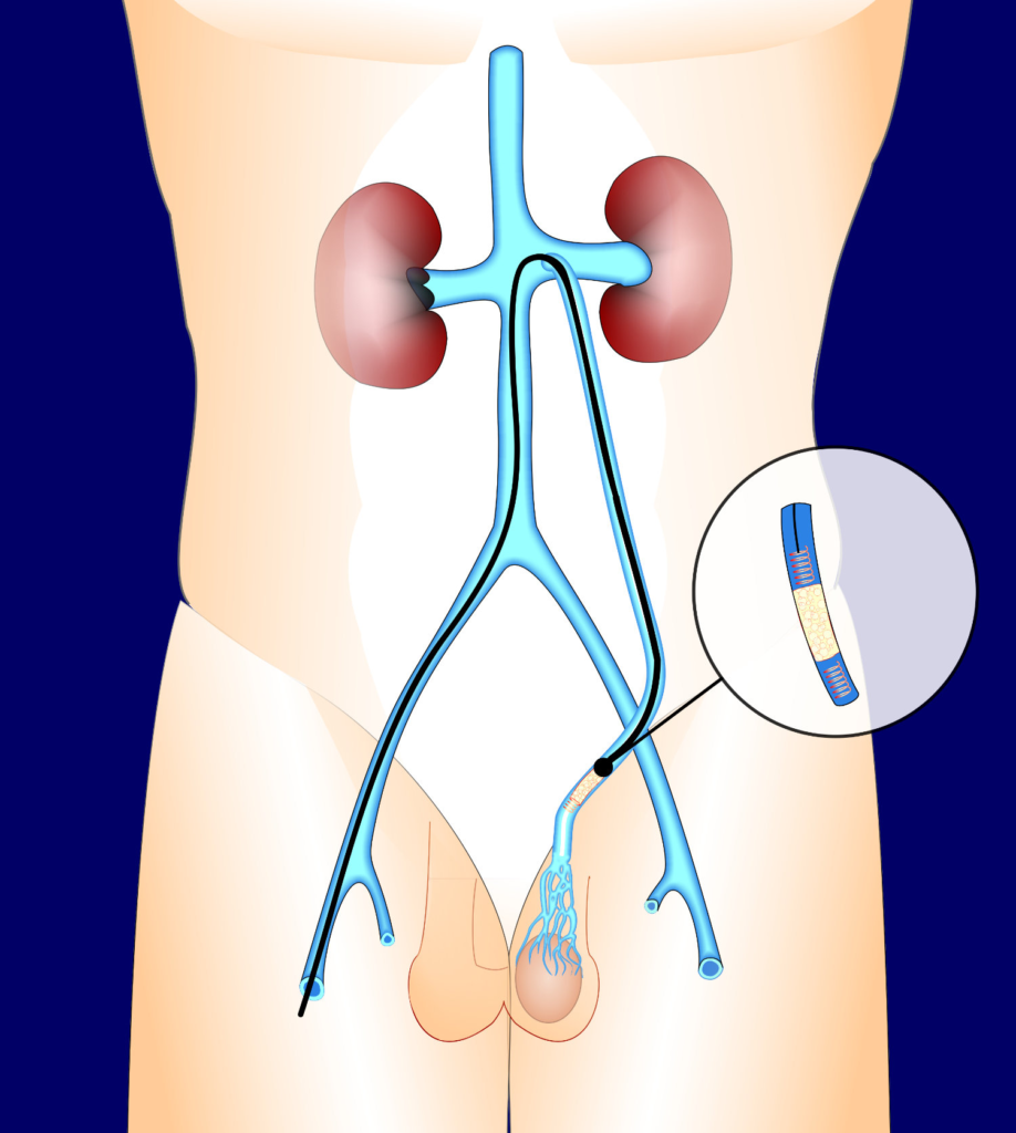 Varicocele Embolization vs Surgery