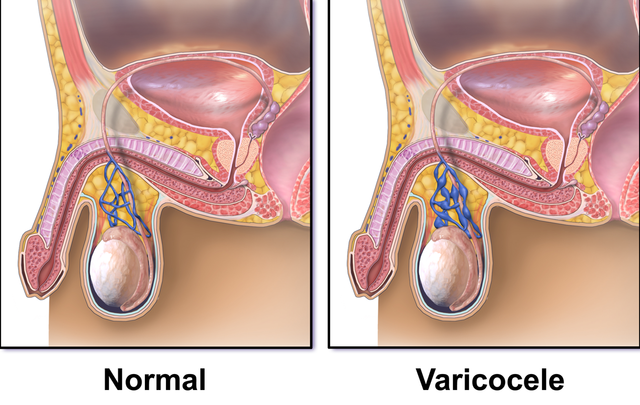Varicocele Doctor Near Me: How to Find the Right Specialist 1 Varicocele Doctor Near Me