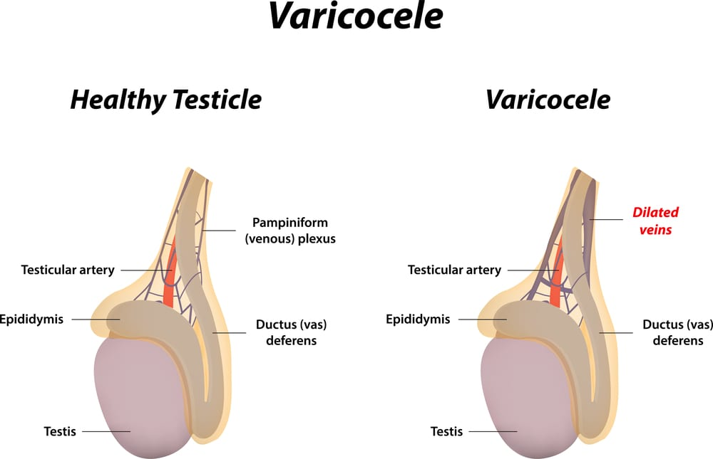 Varicocele Treatment in Indore: Best Doctors, Procedures & Recovery 1 Varicocele Treatment in Indore