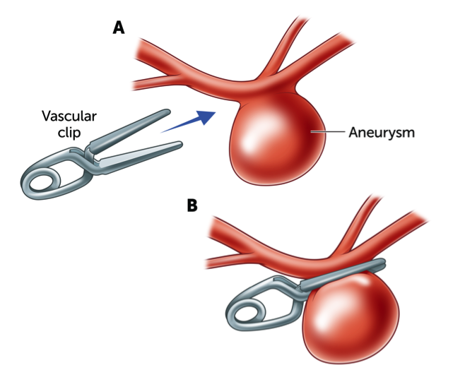 Cerebral Aneurysm Treatment in Indore – Advanced, Safe & Minimally Invasive Care 3 Cerebral Aneurysm Treatment in Indore