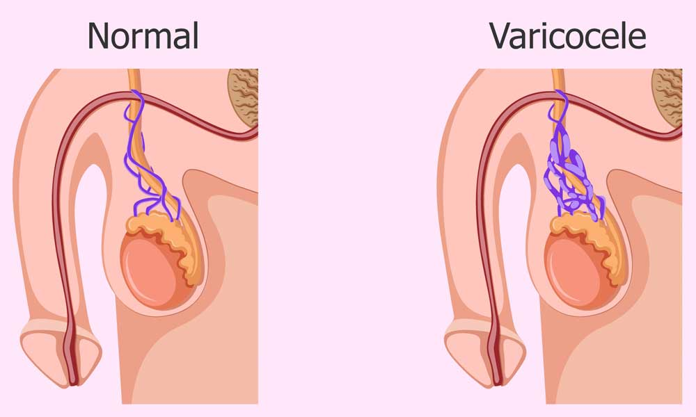 Varicocele Treatment in Indore: Best Doctors, Procedures & Recovery 3 Varicocele Treatment in Indore