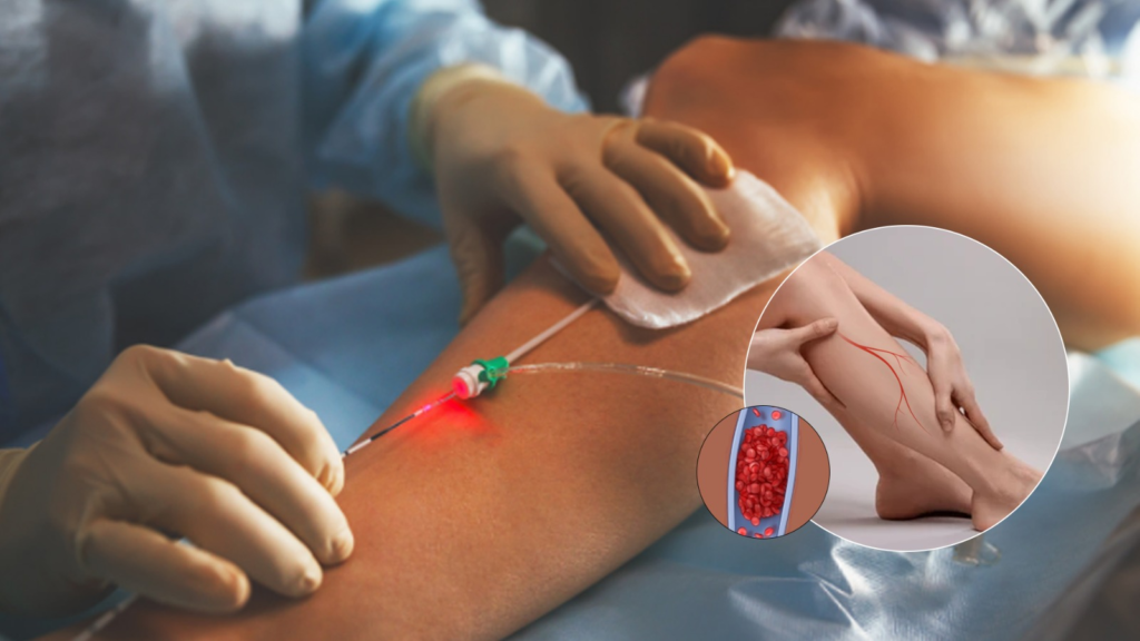 Varicose Veins Treatment in Indore: Options, Cost & Best Doctors 1 Varicose Veins Treatment in Indore