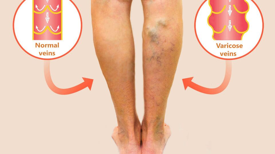 Varicose Veins Treatment in Indore: Options, Cost & Best Doctors 2 Varicose Veins Treatment in Indore