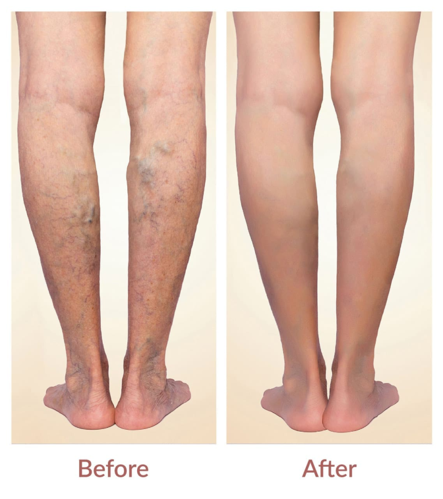 Varicose Veins Treatment in Indore: Options, Cost & Best Doctors 3 Varicose Veins Treatment in Indore