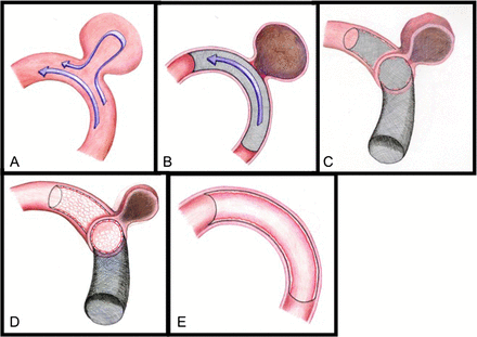 Cerebral Aneurysm Treatment in Indore – Advanced, Safe & Minimally Invasive Care 4 cerebral aneurysm treatment in indore