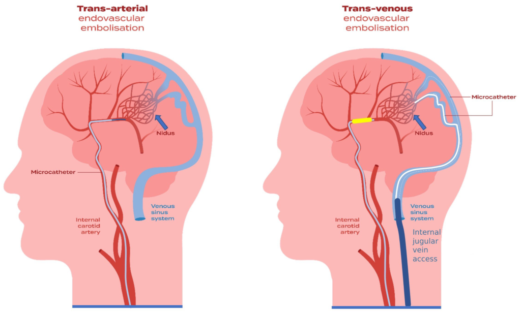 Brain AVM Embolisation in Indore – Advanced Treatment at CARE CHL Hospital 1 Brain AVM Embolisation in Indore