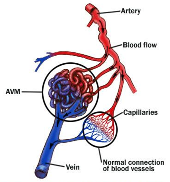 Brain AVM Embolisation in Indore – Advanced Treatment at CARE CHL Hospital 2 Brain AVM Embolisation in Indore