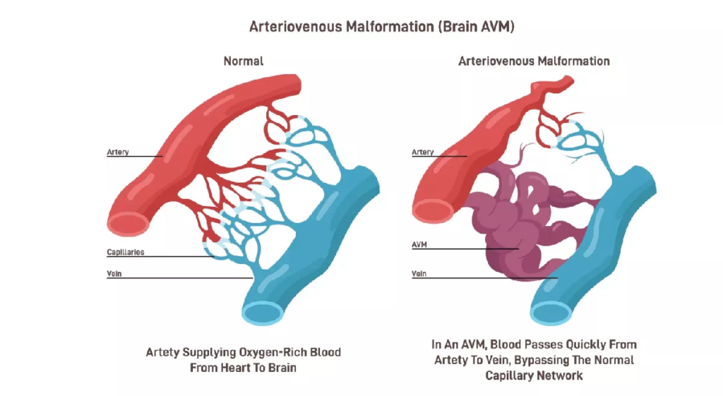 Brain AVM Embolisation in Indore – Advanced Treatment at CARE CHL Hospital 3 Brain AVM Embolisation in Indore