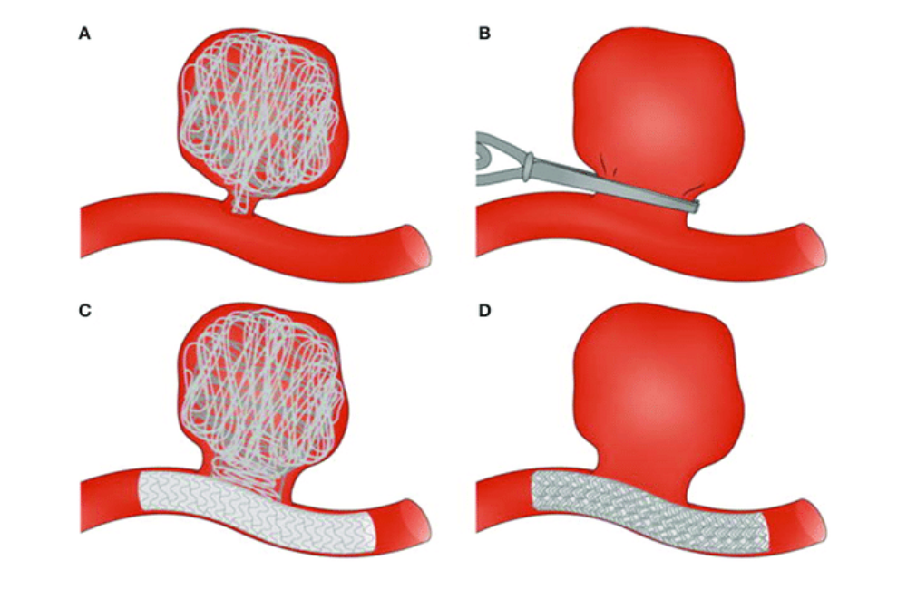 Cerebral Aneurysm Treatment in Indore – Advanced, Safe & Minimally Invasive Care 1 Cerebral Aneurysm Treatment in Indore