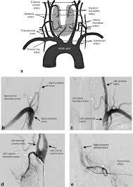 Thyroid Embolization