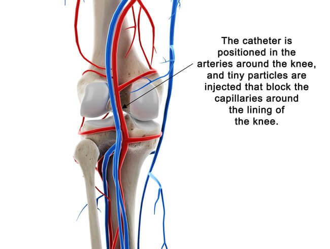 Treatment for Chronic Knee Pain