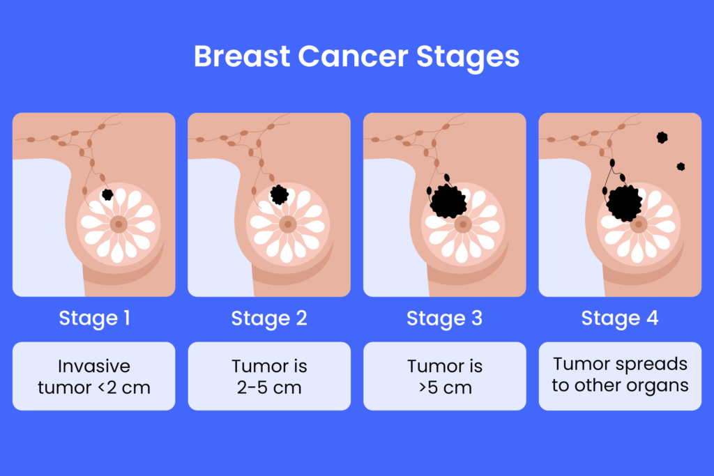 Interventional Radiology in Breast Cancer: A Modern, Minimally Invasive Approach to Treatment 2 Breast Cancer