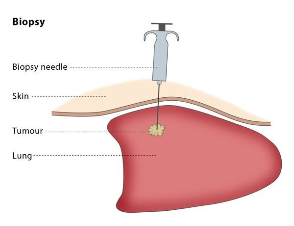 Image-guided Biopsy