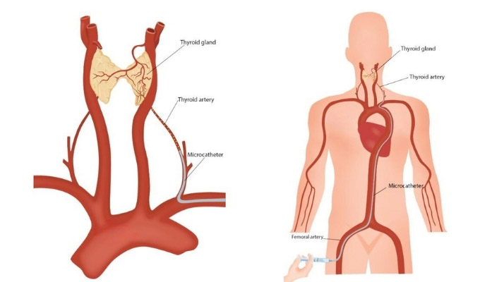 Is Thyroid Embolization Painful? 1 Thyroid Embolization