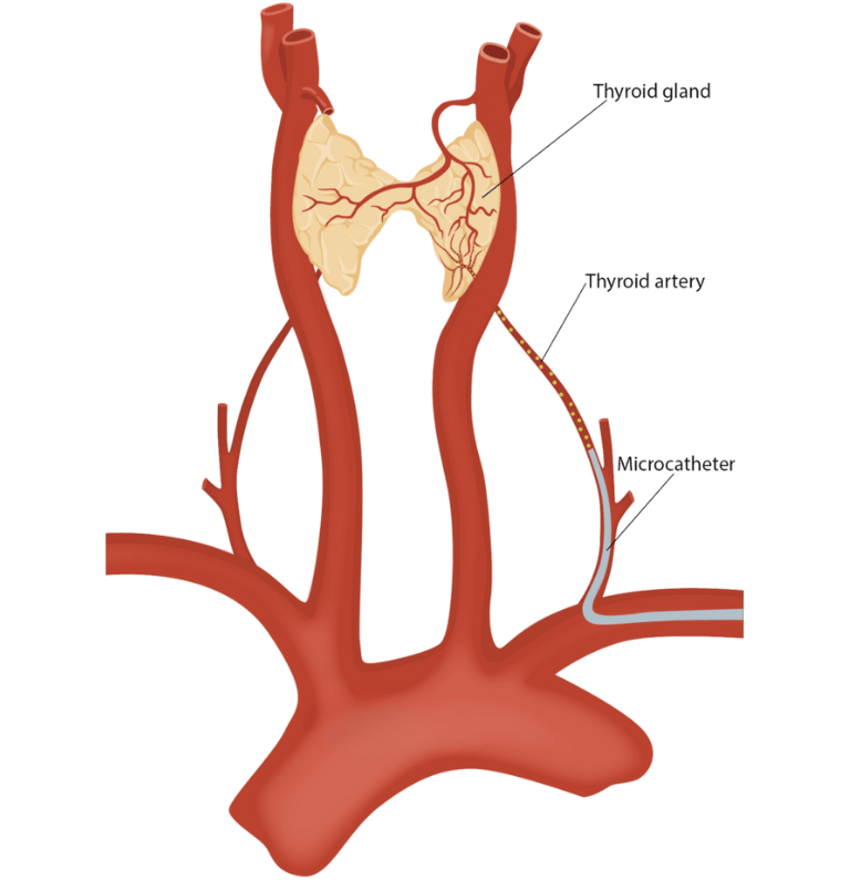 Is Thyroid Embolization Painful? 2 Thyroid Embolization