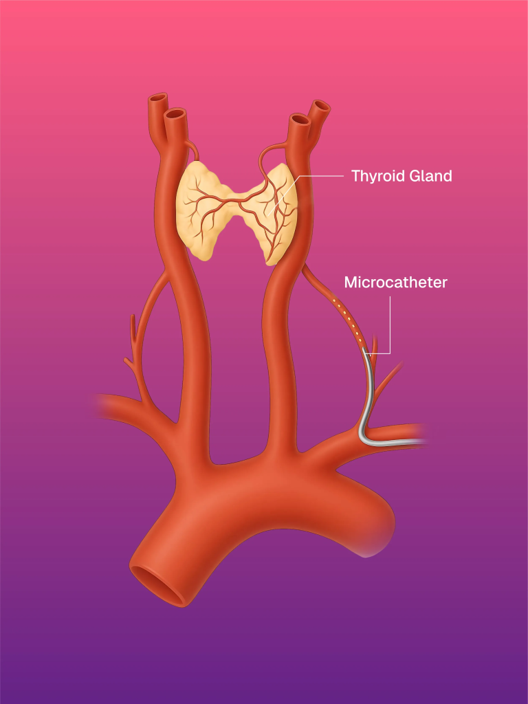 Thyroid Embolization
