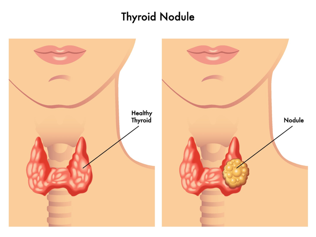 Thyroid Embolization or RFA: Best Treatment Options for Thyroid Nodule 1 Thyroid Embolization