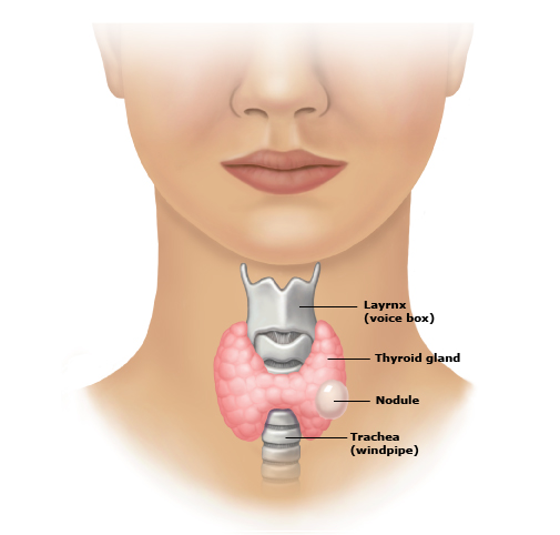 Thyroid Embolization or RFA: Best Treatment Options for Thyroid Nodule 2 Thyroid Embolization
