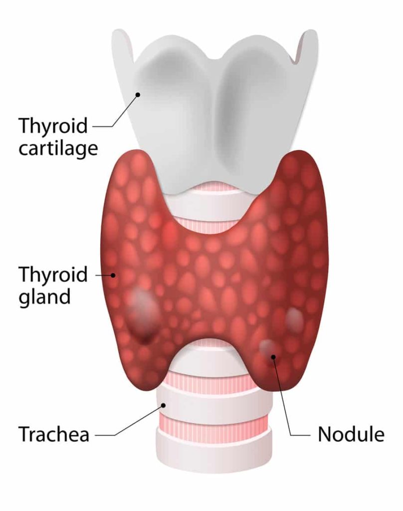 Thyroid Embolization or RFA: Best Treatment Options for Thyroid Nodule 3 Thyroid Embolization