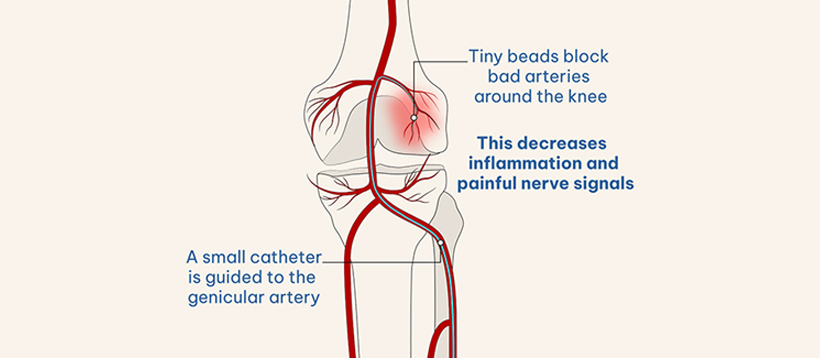 Treatment for Chronic Knee Pain
