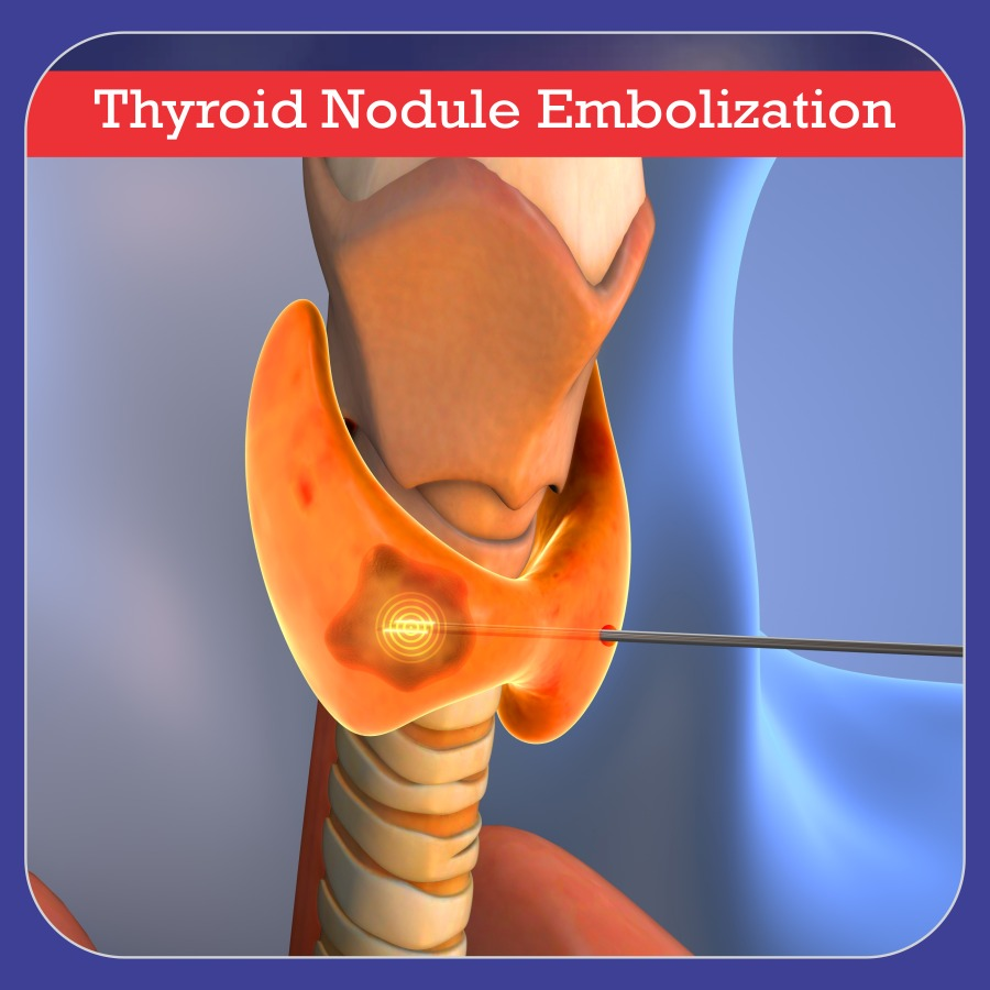 Thyroid Embolization