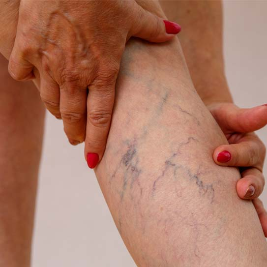 Laser Treatment for Varicose Veins in Indore 3 Laser Treatment for Varicose Veins in Indore