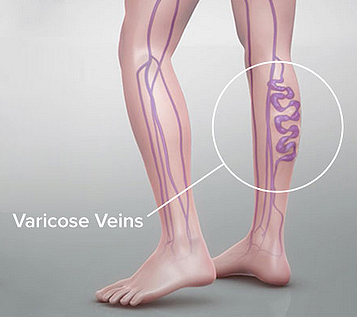 Varicose Veins Pain Relief