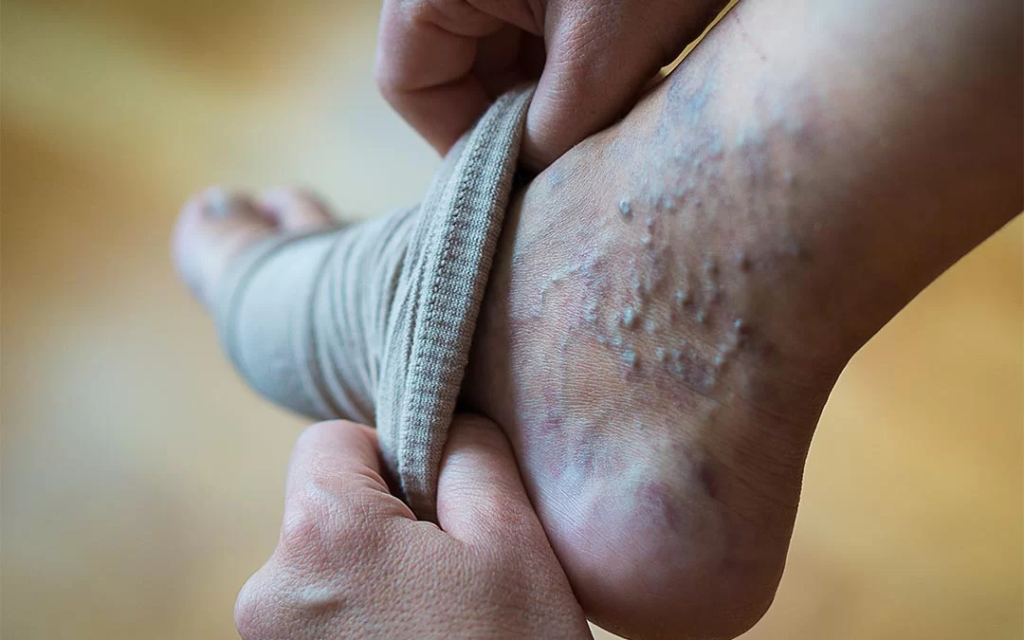 Varicose Veins Pain Relief