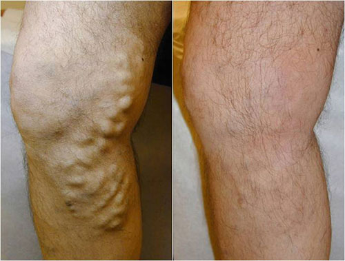 Varicose Veins Pain Relief