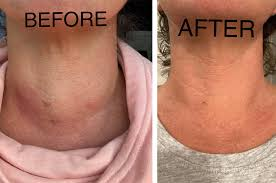 Thyroid Nodules Treatment Without Surgery: Safe & Effective Options 2 Thyroid Nodules Treatment Without Surgery