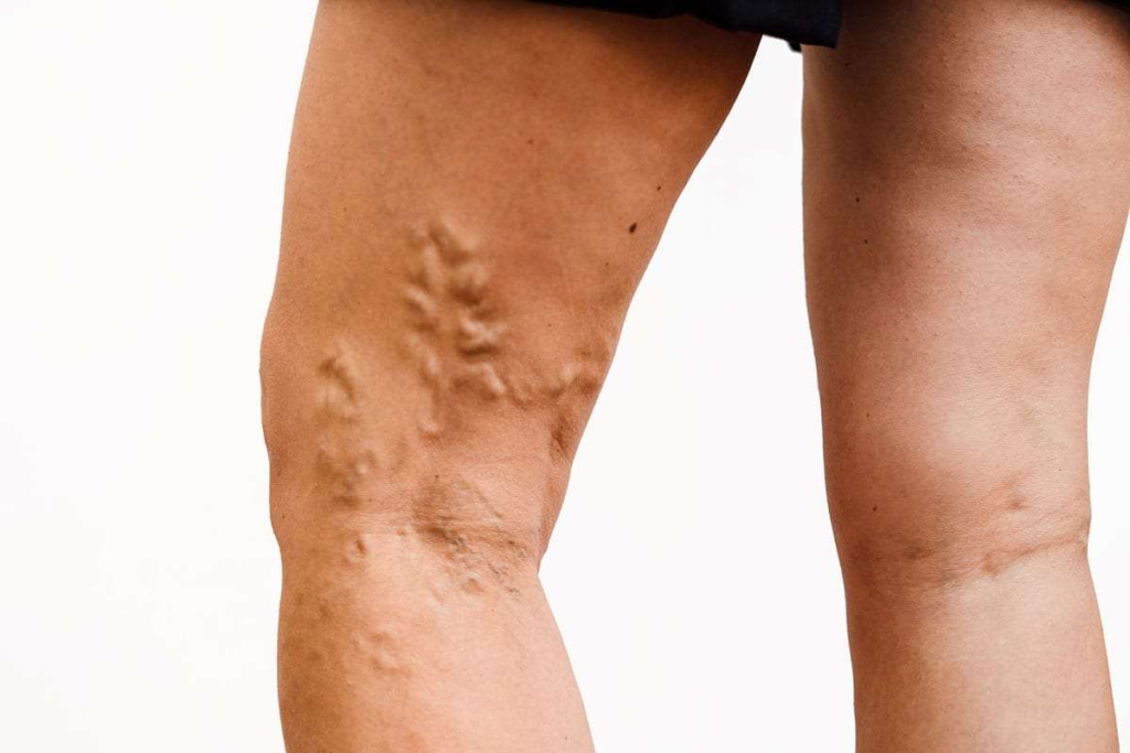 Varicose Veins Causes