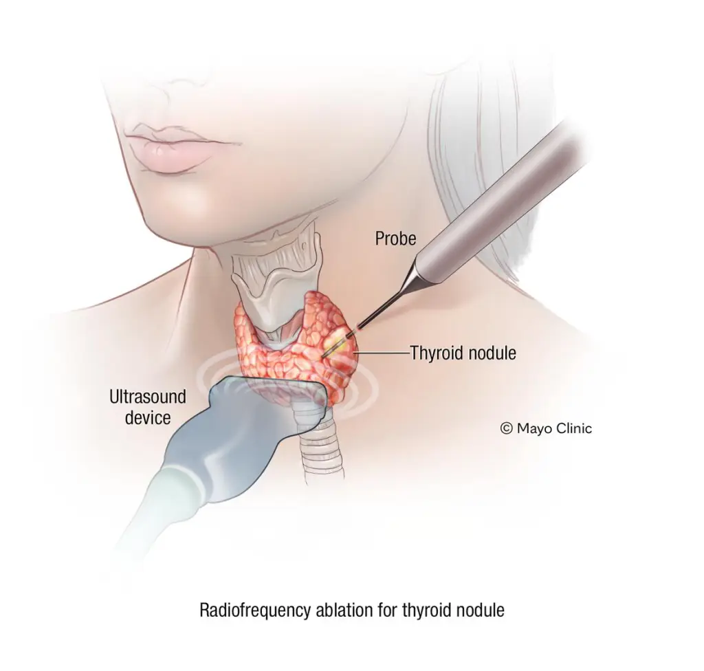 Thyroid Nodules Treatment Without Surgery: Safe & Effective Options 3 Thyroid Nodules Treatment Without Surgery