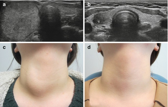 Radiofrequency Ablation for Thyroid in India 