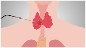 Radiofrequency Ablation for Thyroid in India 