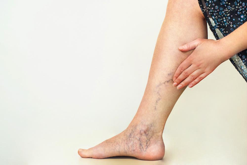 Varicose Veins Symptoms: Early Signs, Causes & When to See a Doctor 1 Varicose Veins Symptoms