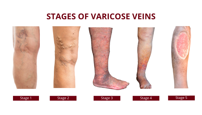Varicose Veins Symptoms: Early Signs, Causes & When to See a Doctor 2 Varicose Veins Symptoms