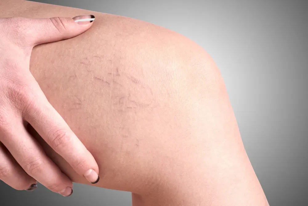 Varicose Veins Symptoms: Early Signs, Causes & When to See a Doctor 3 Varicose Veins Symptoms