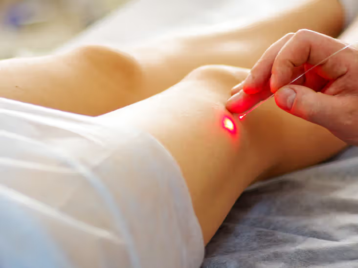 Varicose Veins Treatment Without Surgery